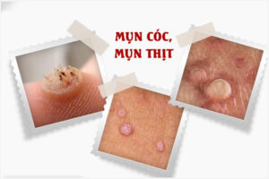 Nổi mụn thịt ở âm đạo là bị gì?