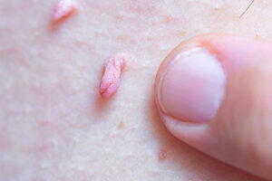 Âm đạo bị nổi hột, nổi hạt là bệnh gì?