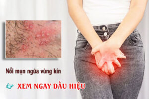 Nổi Mụn Ngứa Vùng Kín – Dấu Hiệu Cảnh Báo Bệnh Phụ Khoa