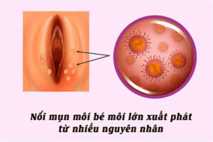 Nổi mụn môi bé môi lớn là bệnh gì?