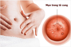 Hiện tượng nổi mụn ở trong tử cung là bị gì?