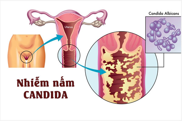 Nam-candida-3