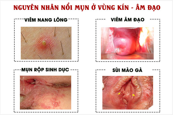 Nguyen-nhan-noi-mun-am-dao