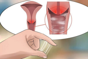 Nhiễm khuẩn nhiễm trùng âm đạo đừng nên xem thường!