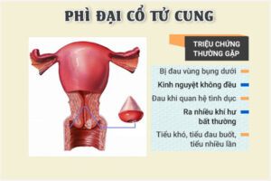 Phì đại cổ tử cung gây ra những tác hại nào?