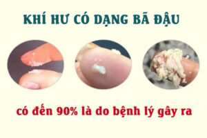 Ra dịch bã đậu là bệnh gì? Cách xử lý an toàn?