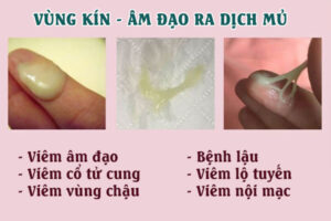 Âm đạo ra dịch mủ nhiều và hôi có sao không?