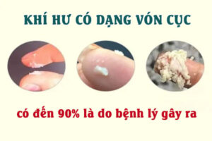 Ra dịch vón cục là dấu hiệu bệnh gì? Cách xử lý hiệu quả ra sao?