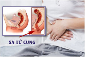 Bệnh sa cổ tử cung là gì nguy hiểm không?