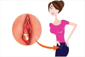 Sưng âm đạo sau khi quan hệ do đâu?