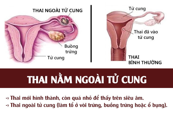 Thai-ngoai-tu-cung