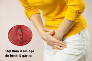 Mọc thịt thừa ở âm đạo là bị gì? Có sao không?