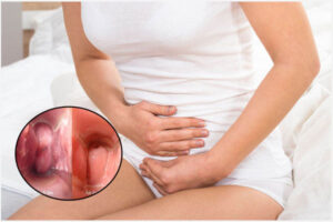 Thịt thừa ở vùng kín: Nguyên nhân và Cách xử lý an toàn