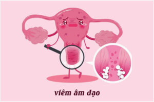 Viêm âm đạo cấp và mãn tính: Triệu chứng và Cách khắc phục hiệu quả