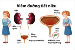 Nguyên nhân viêm đường tiết niệu nữ và Cách khắc phục hiệu quả