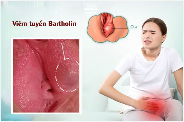 Viem-tuyen-bartholin