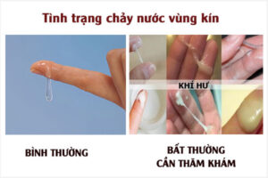 Âm đạo bị chảy nước nhiều có sao không?