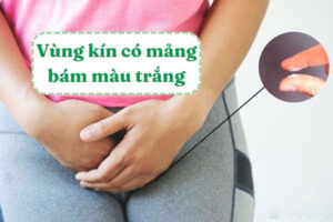 Vùng kín có mảng bám màu trắng là bị bệnh gì?