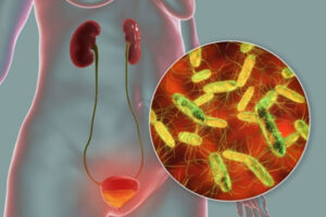 Nhiễm khuẩn nhiễm trùng đường tiểu bệnh dễ gặp, khó trị ở nữ giới