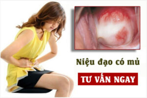 Niệu đạo có mủ: Dấu hiệu cảnh báo bệnh lý nguy hiểm