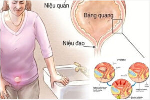Đi tiểu bị đau do đâu? Có ảnh hưởng gì sức khỏe không?