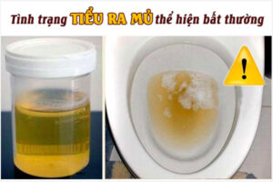 Tiểu ra mủ: Triệu chứng, Nguyên nhân và Cách điều trị