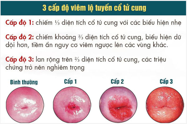 Viem-lo-tuyen-co-tu-cung-4