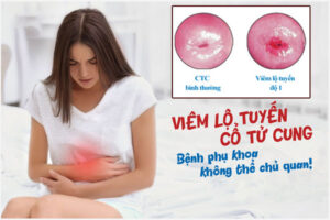 Viêm lộ tuyến cổ tử cung cấp độ 1: Biểu hiện và Cách khắc phục hiệu quả