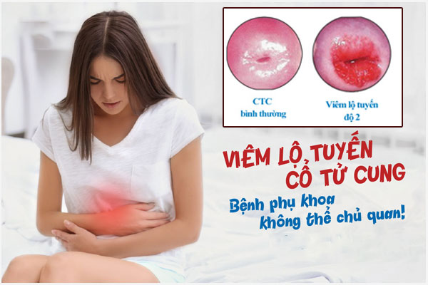 Viêm lộ tuyến cổ tử cung cấp độ 2: Biểu hiện và Cách khắc phục hiệu quả