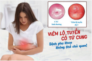 Viêm lộ tuyến cổ tử cung cấp độ 3: Biểu hiện và Cách khắc phục hiệu quả