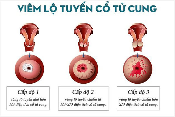 Viem-lo-tuyen-co-tu-cung