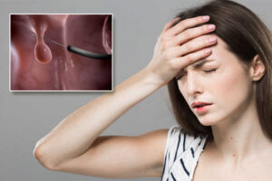 Cắt Polyp cổ tử cung là gì? Địa chỉ cắt polyp ở đâu an toàn và uy tín