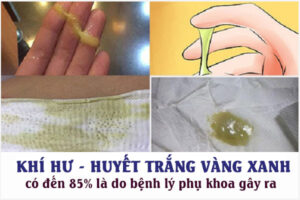 Ra khí hư màu vàng xanh là bị gì? Cách khắc phục hiệu quả