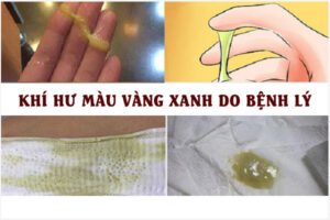 Nữ giới đừng nên chủ quan khi ra dịch màu vàng xanh bất thường!