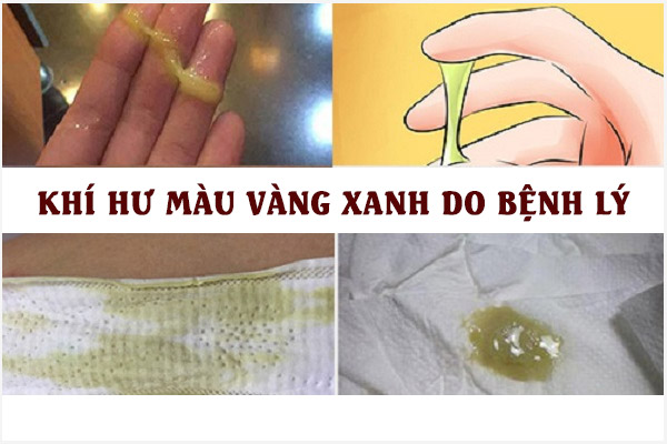 Nữ giới đừng nên chủ quan khi ra dịch màu vàng xanh bất thường!