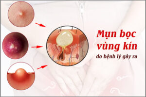 Mọc mụn bọc ở vùng kín nữ dấu hiệu cảnh báo mắc bệnh nguy hiểm