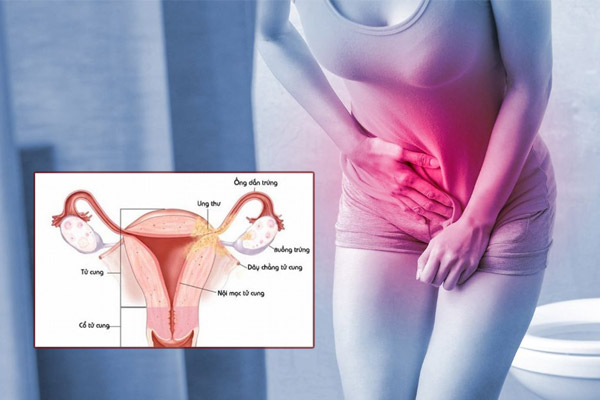 Cách chữa tiểu buốt ở nữ cùng các bác sĩ chuyên khoa ưu tú